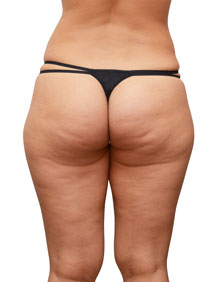 Cellulite sur les cuisses